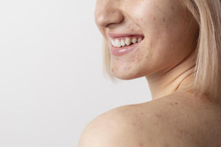 Acneea corporala - solutii si produse eficiente de combatere - skinseen.ro