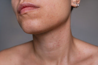 Beneficiile zincului în rutina de skincare pentru piele sensibilă sau reactivă