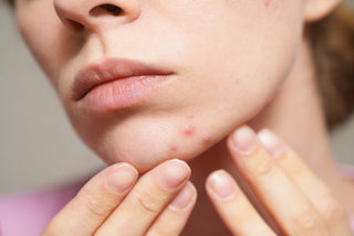 Acnee hormonală vs. acnee bacteriană: cum identifici cauza și alegi tratamentul potrivit