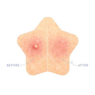 STAR SPOT PATCH 80 PATCHES – Plasturi Hidrocoloizi Pentru Acnee Cu Niacinamida Si Ceramide